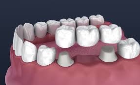 Dental crown and bridge